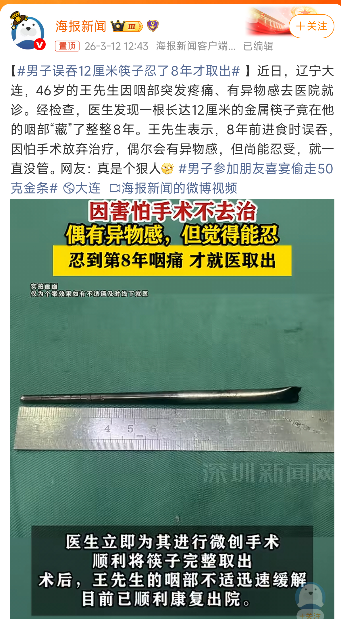 男子误吞12厘米筷子忍了8年才取出不是误吞筷子？ 还忍了8年？ 这也太能忍了