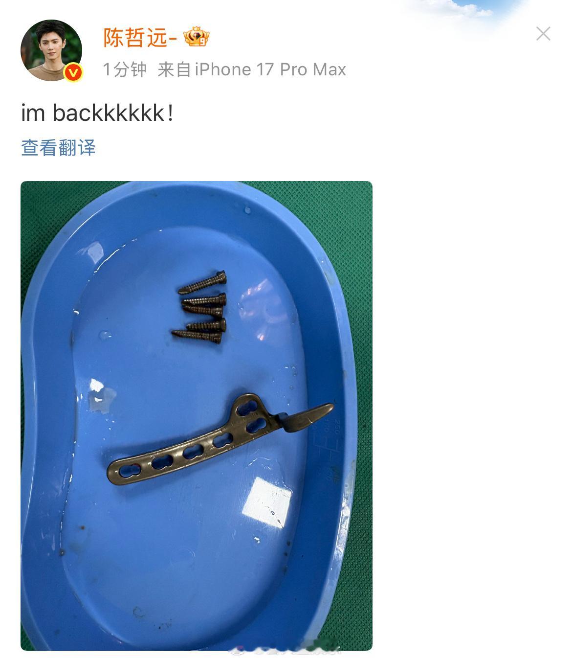 干啥都会汇报进度的好哲远陈哲远晒手术取出的钢钉陈哲远取完钢钉了