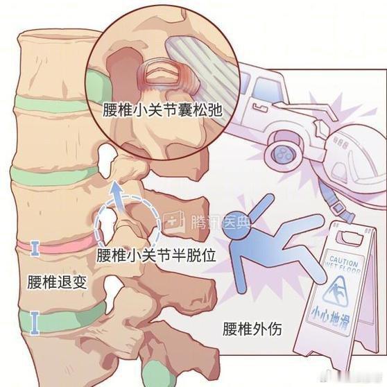 《闪腰怎么快速恢复？如何保护你的腰？》闪腰其实是“急性腰扭伤”的俗称，往往由运动