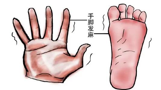 经常手脚麻木怎么办呢？大家好，我是中医骨科任医生，今天给大家说一下手脚麻木的原因