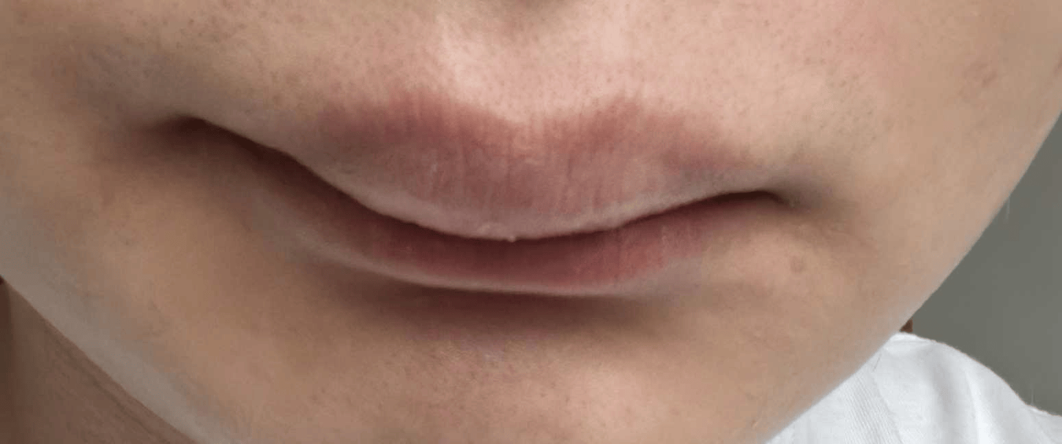 Fly发布嘴巴照片：吃口抄手，嘴巴给烫废了