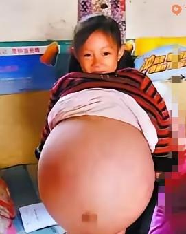 2010年山西这幕太戳心！
4岁女孩腹大如孕妇，
医生断言活不过三月，
父母散尽