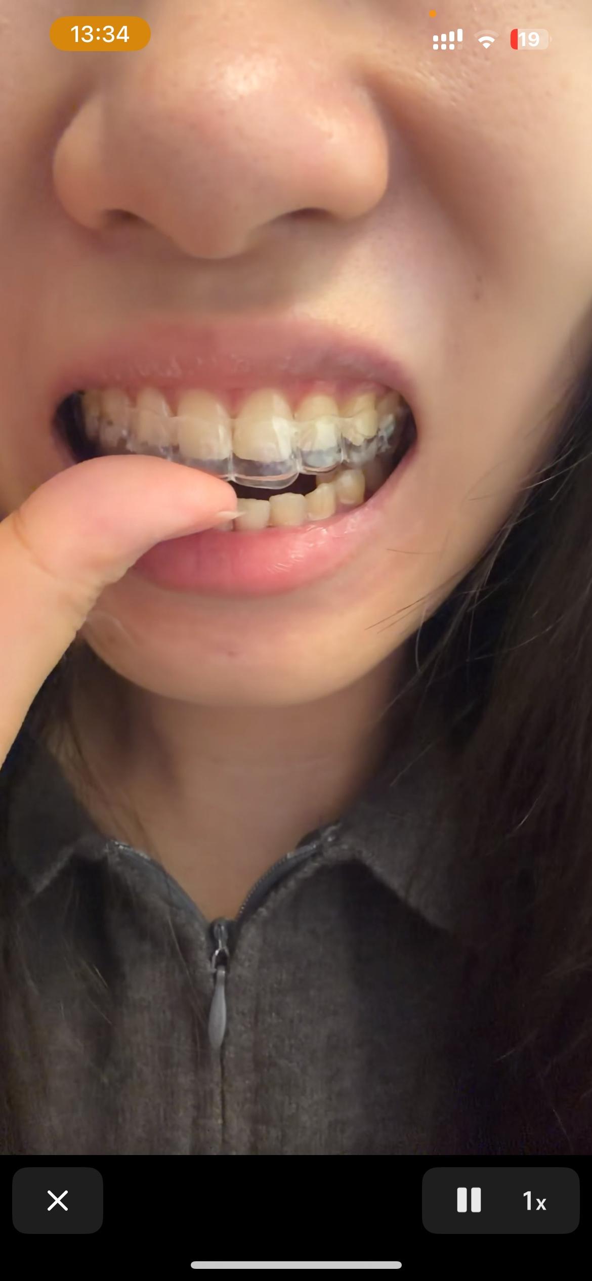 河南一女子花3万矫正牙齿，戴了3年牙套拆掉后，保持器又戴了2年，结果才一周没戴保