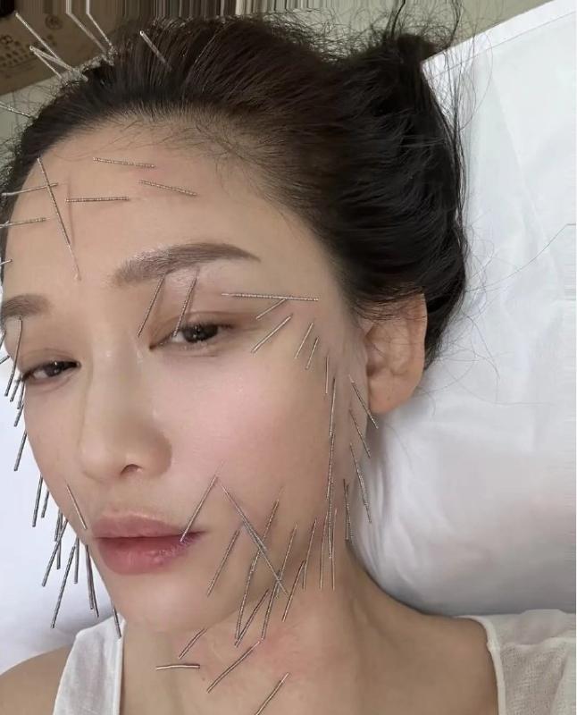 陈乔恩对自己还是太狠了
为了保养，全身上下扎几百针，做针雕项目，之前被爆出为了保
