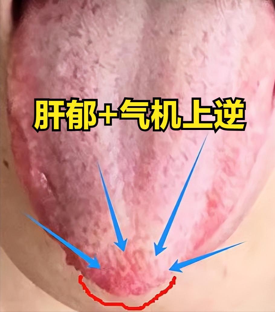 这种舌尖凸起的肝郁舌，最怕错用柴胡疏肝

虽然舌边鼓胀，但舌尖明显凸起，这说明患