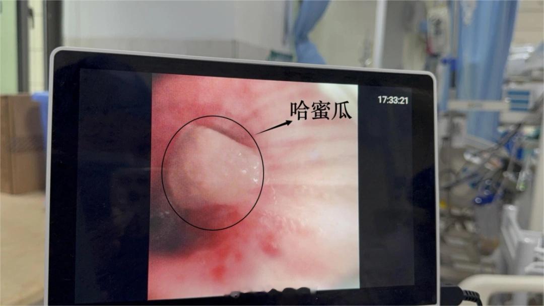 【一块哈密瓜差点要了71岁老人的命，专家称老人误吸后靠咳嗽很难排出】近日，湖南省