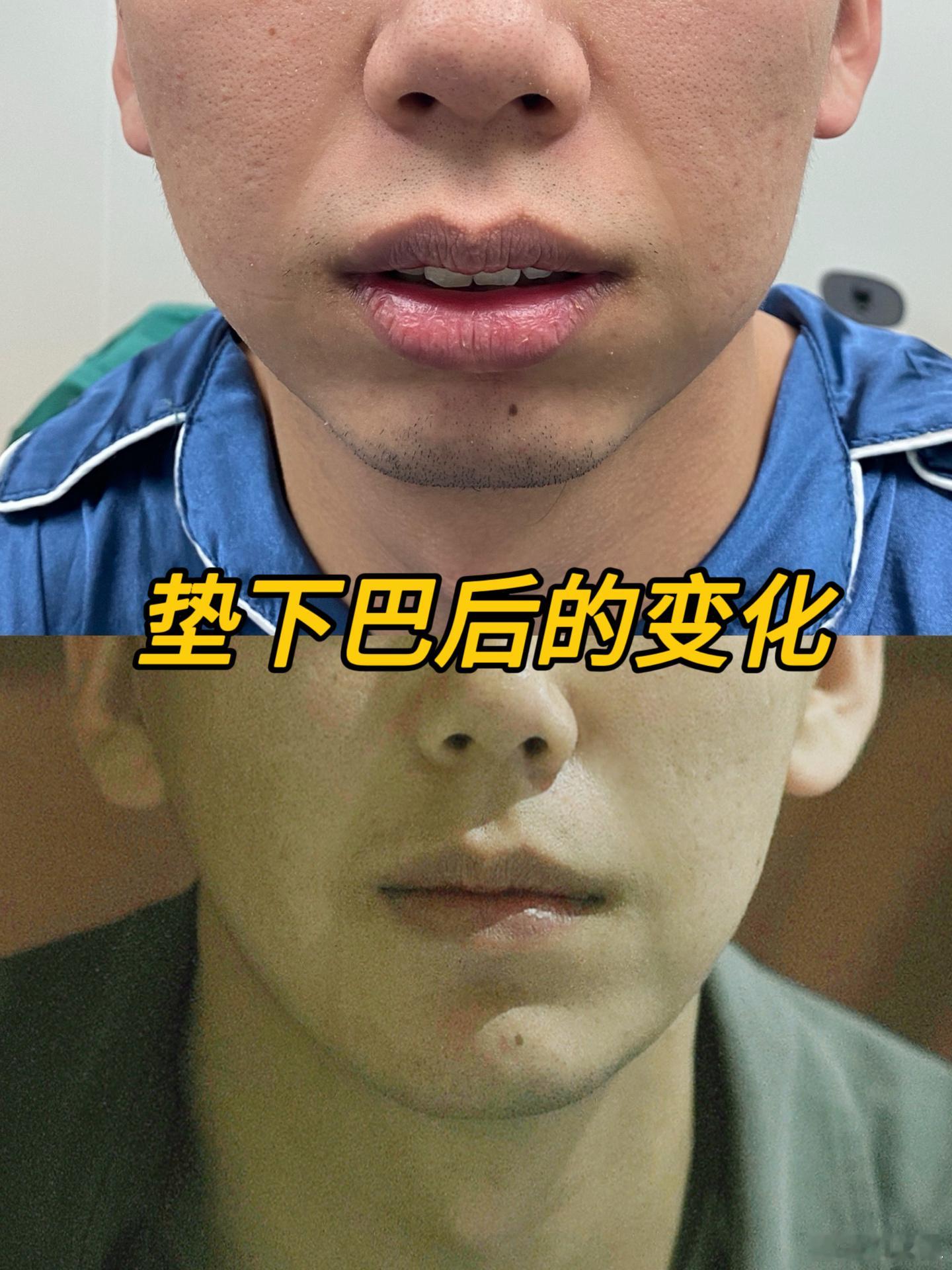 男士假体垫下巴后的变化～ 