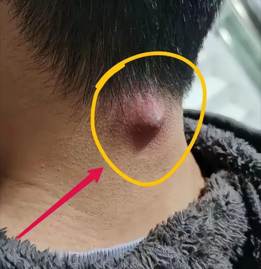 网友：脖子后面长了这么大一个疼死我了，低头摇头都疼？怎么办呢？家人们你们说应该应