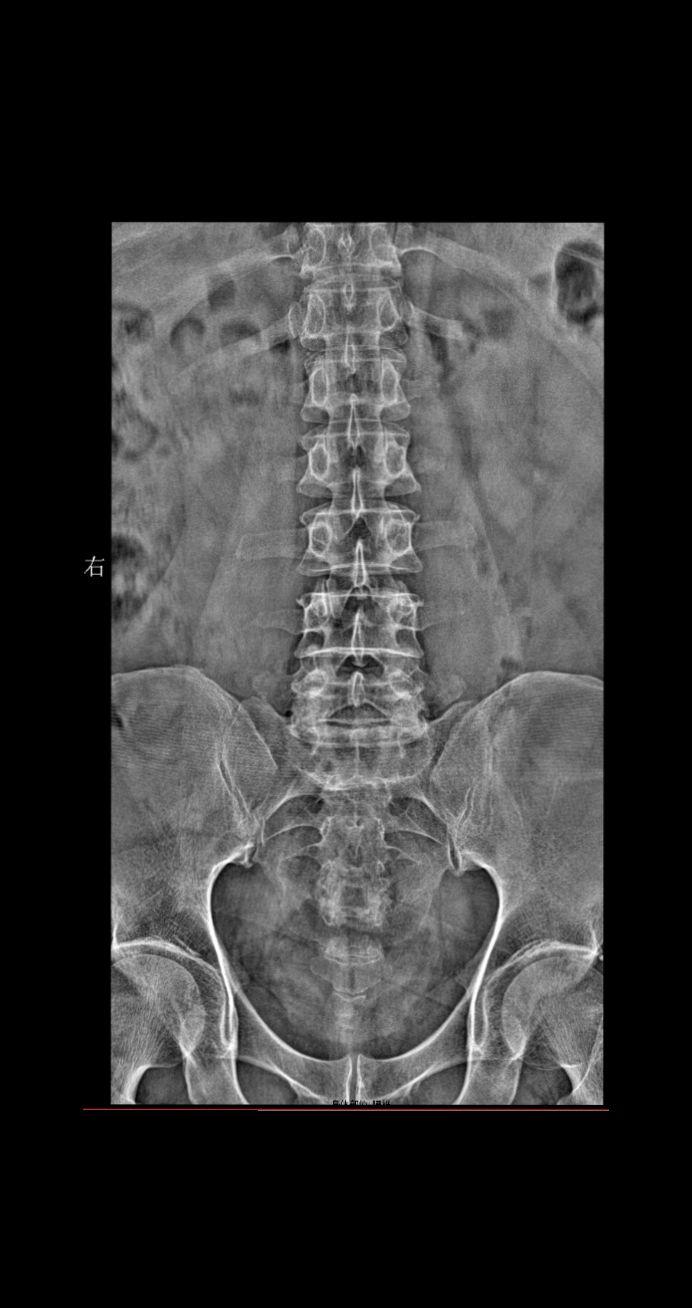 来了来了ok 大家踊跃参与讨论 患者主诉:男 52y 下肢麻木 酸疼 ...