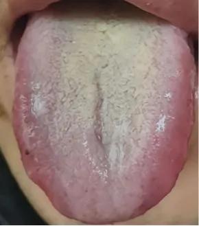 这个患者舌苔的表象很容易误诊，会误判为湿热，实则脾阳亏虚。

之前讲过，观舌不仅