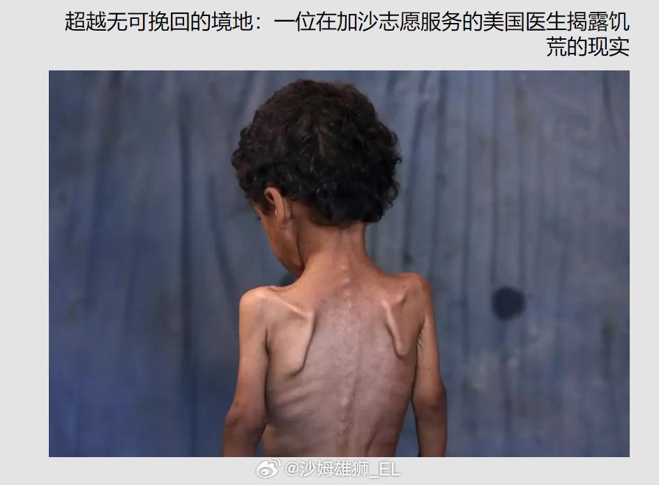在加沙地区志愿服务的美国医生马克·布劳纳博士认为，如果以色列对加沙的食物封锁持续
