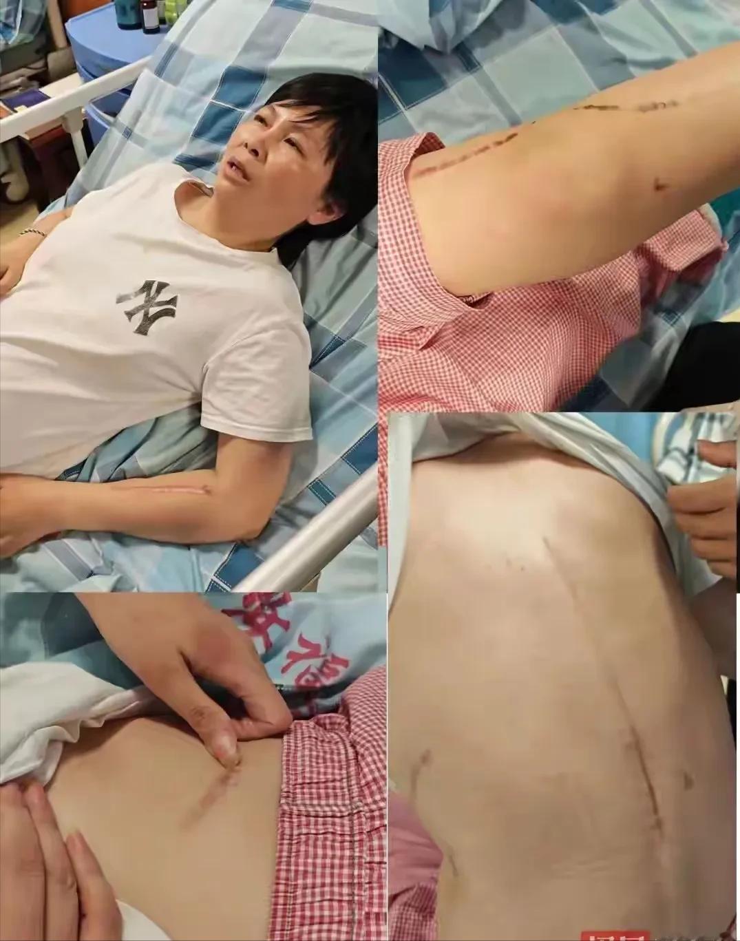 6月1日报道，江西吉安，一40岁女子备孕三年，肚皮扎满了针眼，好不容易等来了试管