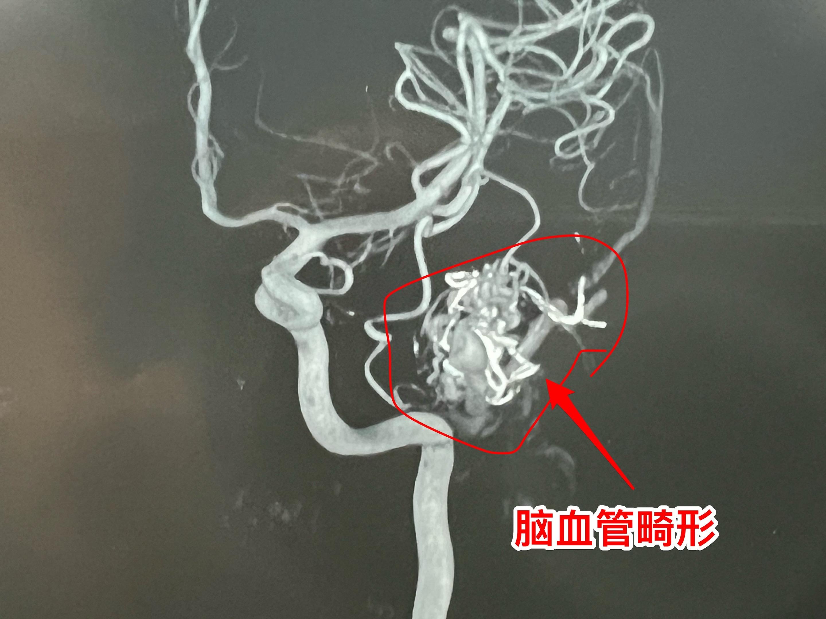 脑血管畸形破裂是青少年最常见的脑出血病因。2025年7月30日，山东省...
