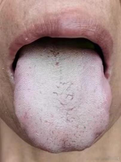 《大众点评脾虚湿困科普》舌胖、齿痕、厚白苔、有裂纹？读懂身体的脾虚湿气信号舌头是