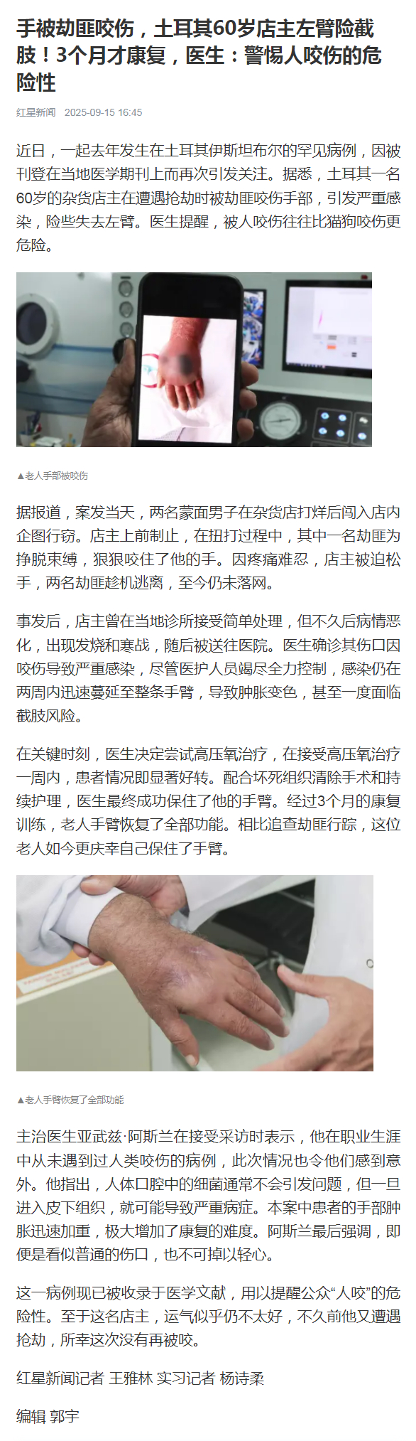 【#土耳其店主手被劫匪咬伤险截肢#！3个月才康复，医生：警惕人咬伤的危险性】近日