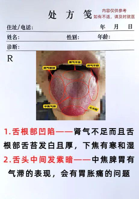 舌象怎么看？中医分享一则案例教会你！自己的健康自己测！

大家好，今天琚医生给大