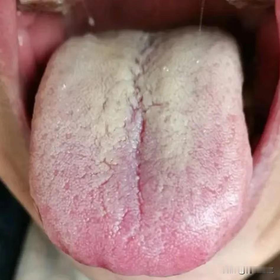 舌象分析：阴虚+湿热 还有脾虚和血瘀

1、“舌色红，舌中绛红”——舌色是气血之