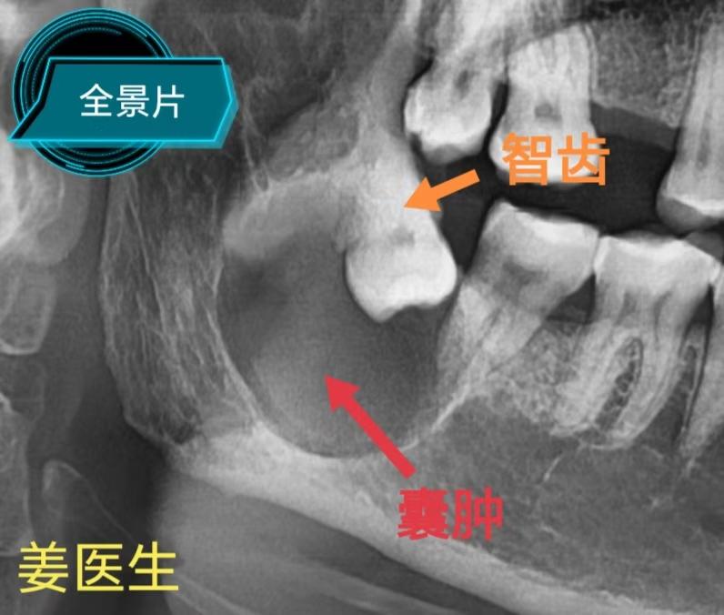 含牙囊肿。外地“含牙囊肿”患者，累及下牙槽神经，拒绝全麻手术。经人介绍...