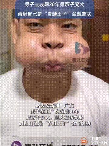 广东一名男子在一家工厂里吹玻璃吹了30年，没想到导致腮帮子变大，肌肉拉伤变形，现