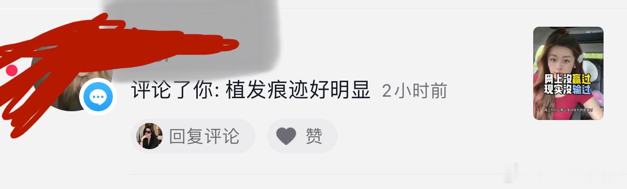 天地良心，真没植发，只是脱过发际线，当初觉得发际线太低了 