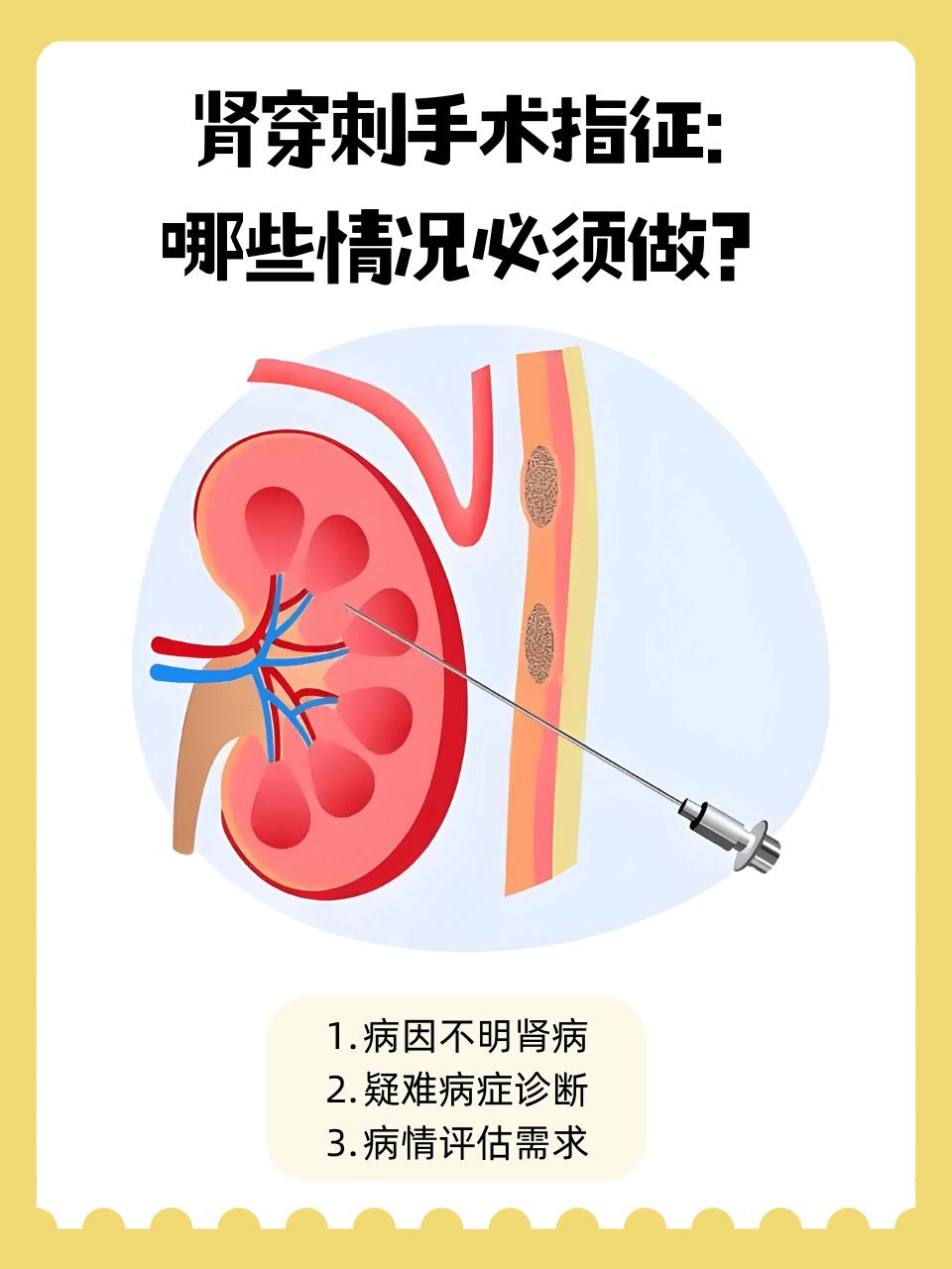 肾穿刺活检：做与不做的利弊总结:
 
一、做肾穿刺（肾活检）的好处
 
1. 精