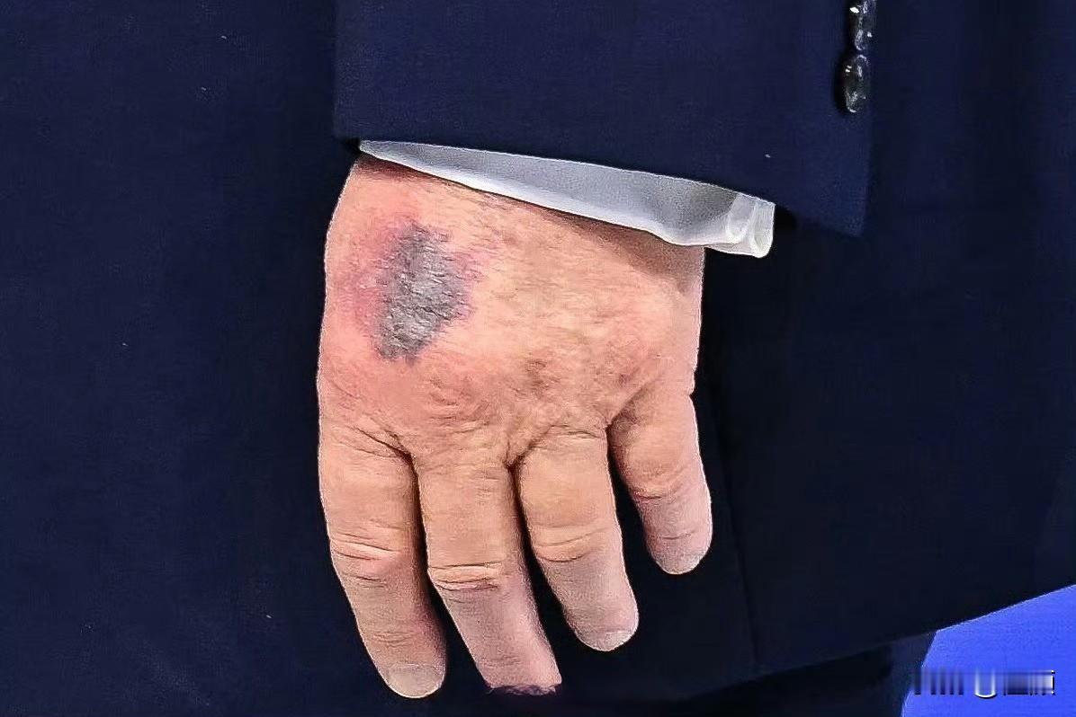 特朗普左手背再现新瘀青…当地时间1月22日，特朗普在达沃斯“加沙和平委员会”签约