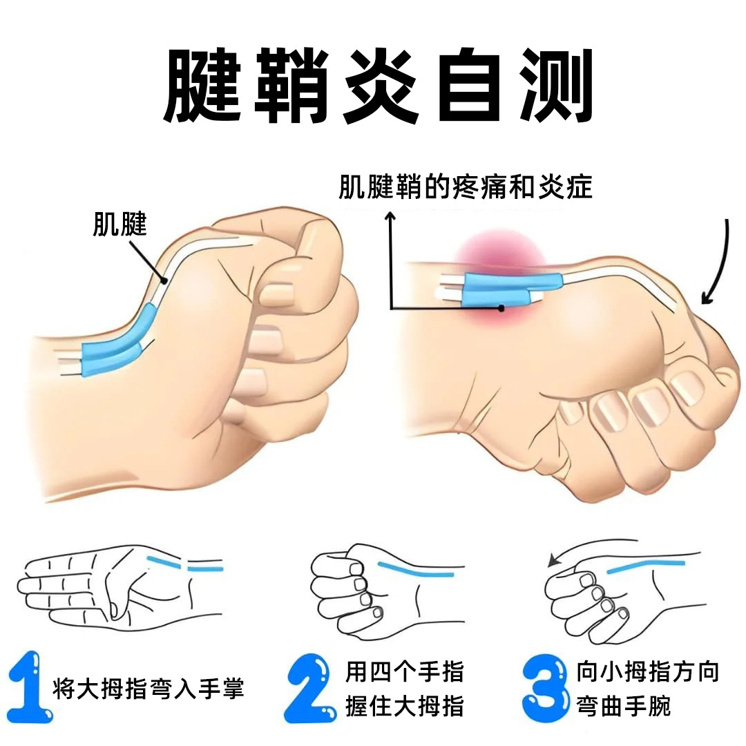 腱鞘炎 7月的最后一天，聊聊打工人的手腕疼痛——腱鞘炎，来给大家分享 2 个关键
