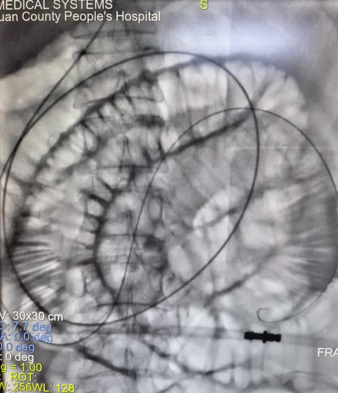 直肠癌术后3年，近期反复肠梗阻，胃管减压 直肠癌术后3年，近期反复肠梗...