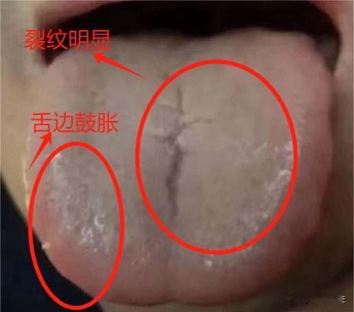 脾肾阳虚，用桂附地黄芄没效果？其实答案都在舌头上，这个问题不搞明白，怎么补都没用