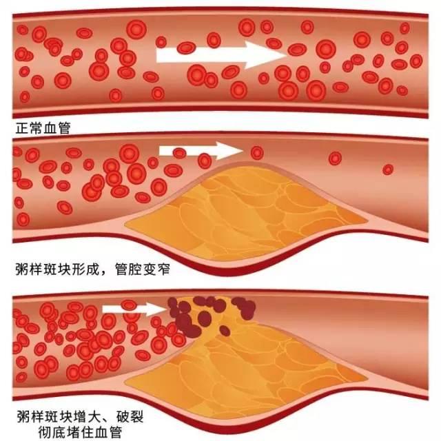 血管堵不堵，看这四个地方就能知道，早知道大家早省心

超过40岁的朋友，身体有这