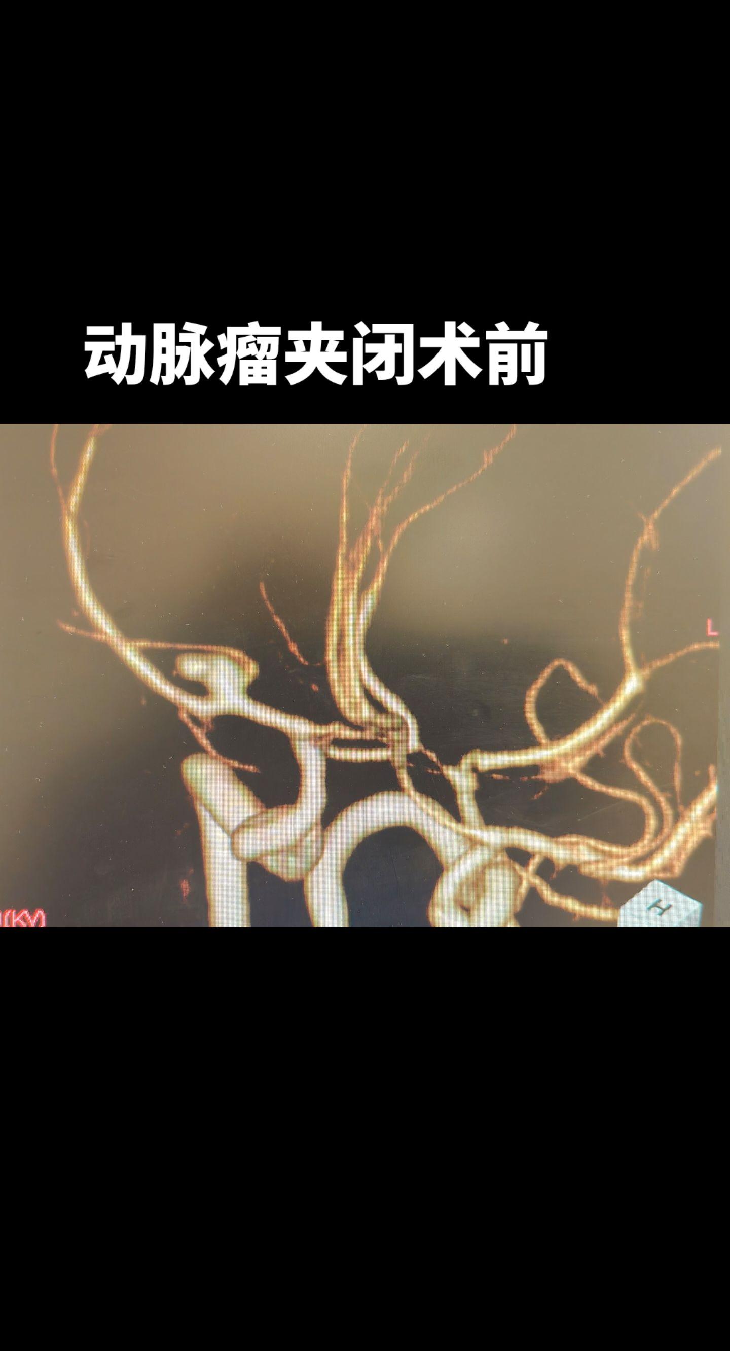 脑动脉瘤破裂开颅夹闭，蛛网膜下腔出血