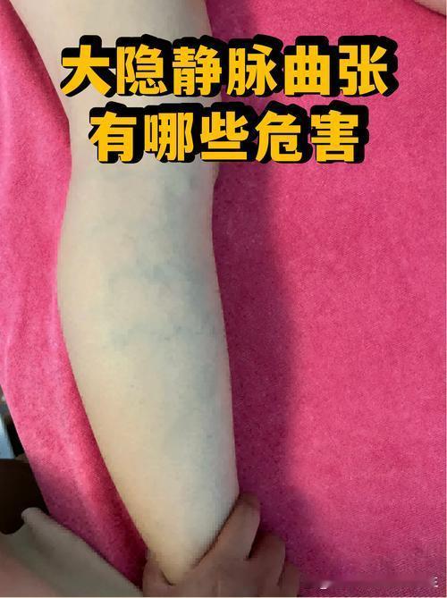 前阵子我的小腿血管突然红肿发硬，轻轻触碰都钻心疼，走路一瘸一拐特别难受，去医院检