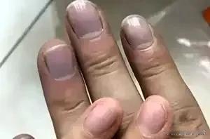 指甲发紫别大意！六旬大爷因忽视指甲发紫症状差点丧命
一大爷指甲看起来紫紫的有三个