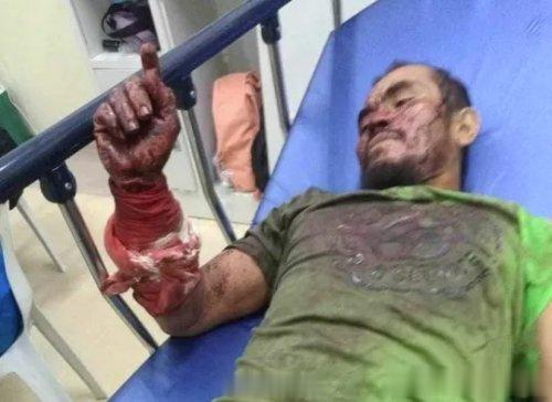 男子被3米巨蟒缠身：咬死蟒蛇自救据报道，在菲律宾薄荷岛安特克拉镇，一名男子不仅成