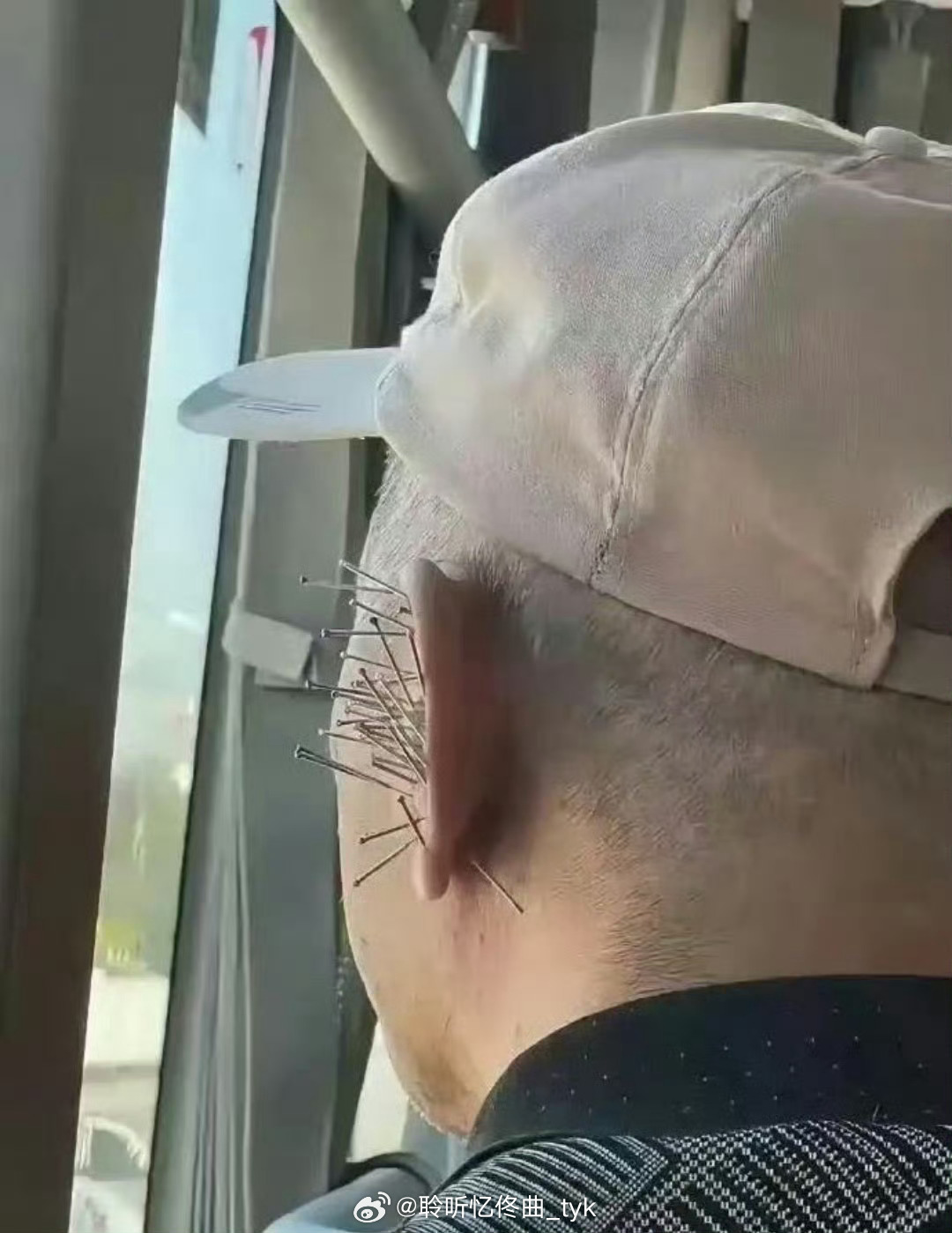 在车上遇见一个爷爷，耳朵扎满了针，这有啥作用吗？ 