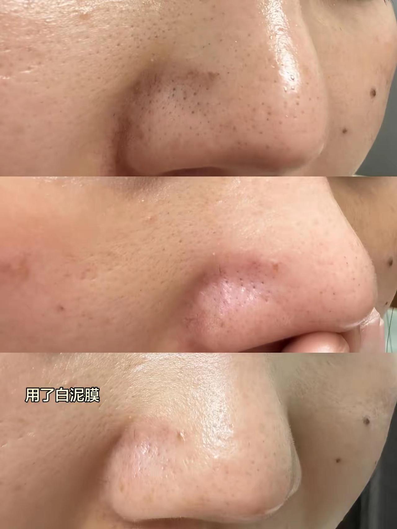 白泥膜 3到4天用一次，你会得到一张干净的脸！