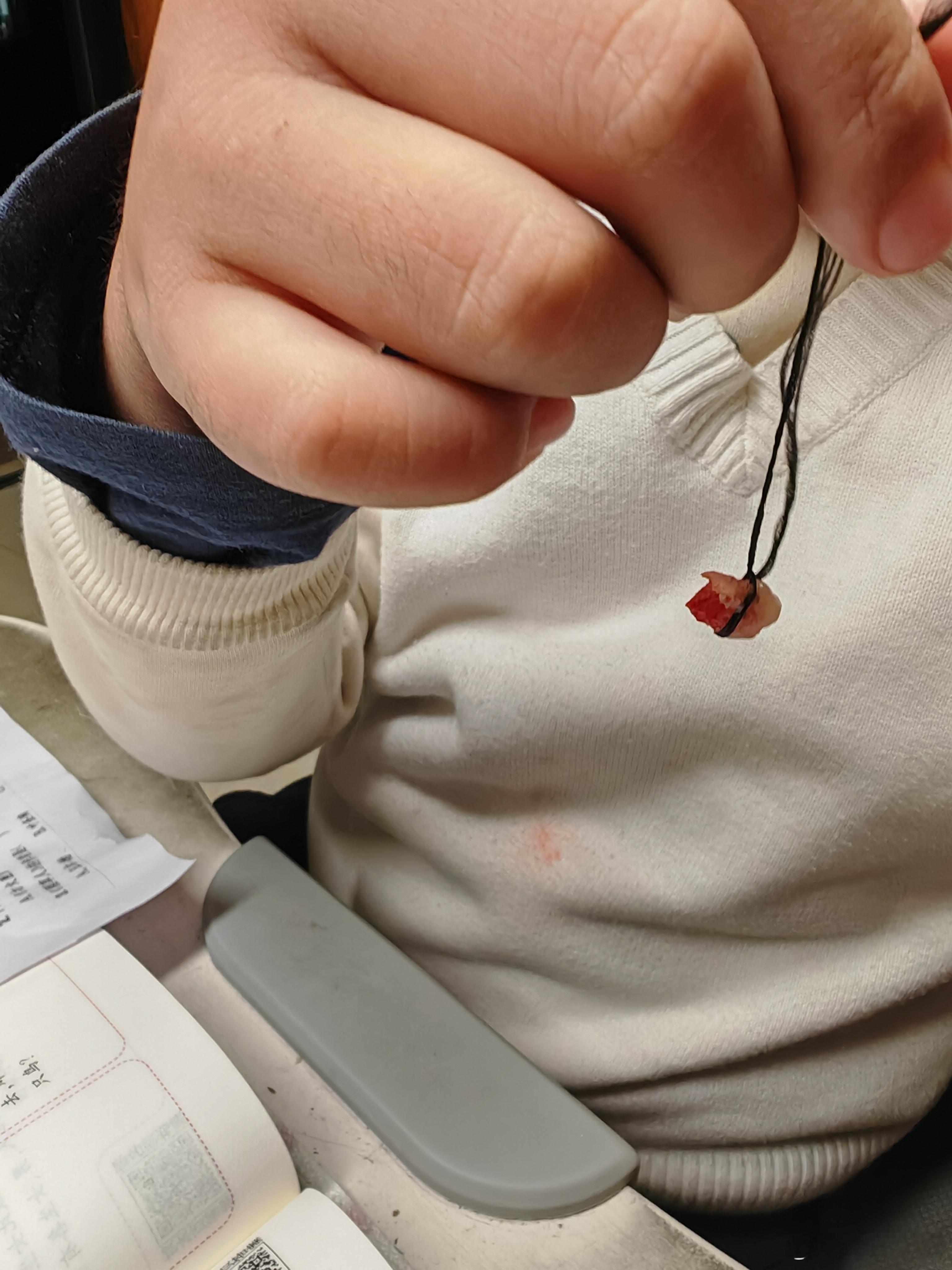 男子八岁，发长齿更，祖传拔牙 