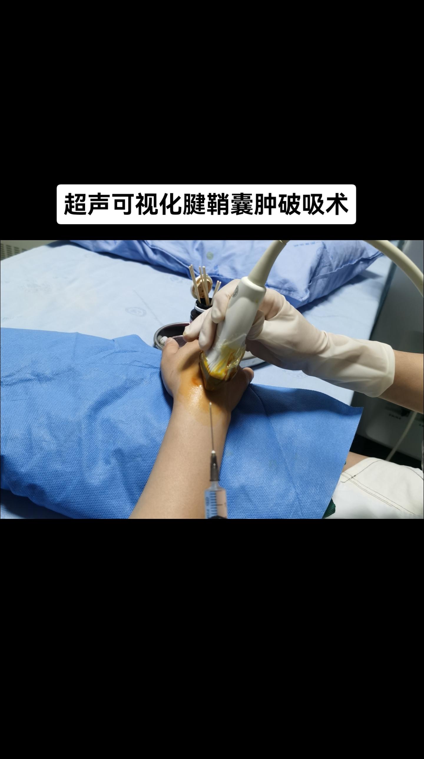看的清楚，吸的干净，不伤邻居。针管里的是啥？生理盐水，稀释囊液好抽吸。囊液是啥？粘液带拉丝儿