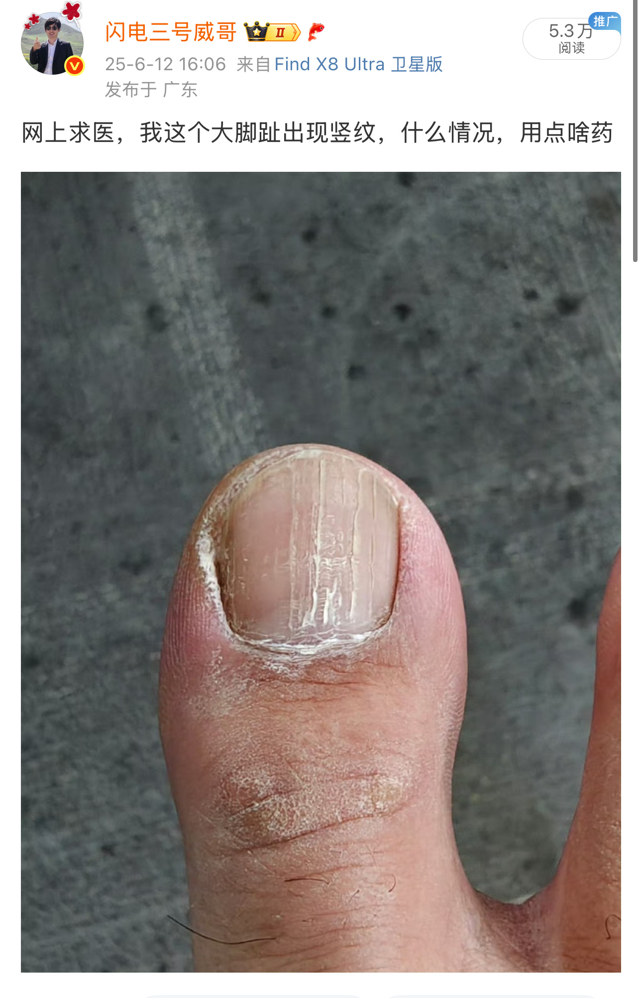 人言可畏，因为脚踝受伤，穿拖鞋来公司上班，同事看到我的大脚趾有竖纹，说和他家人情