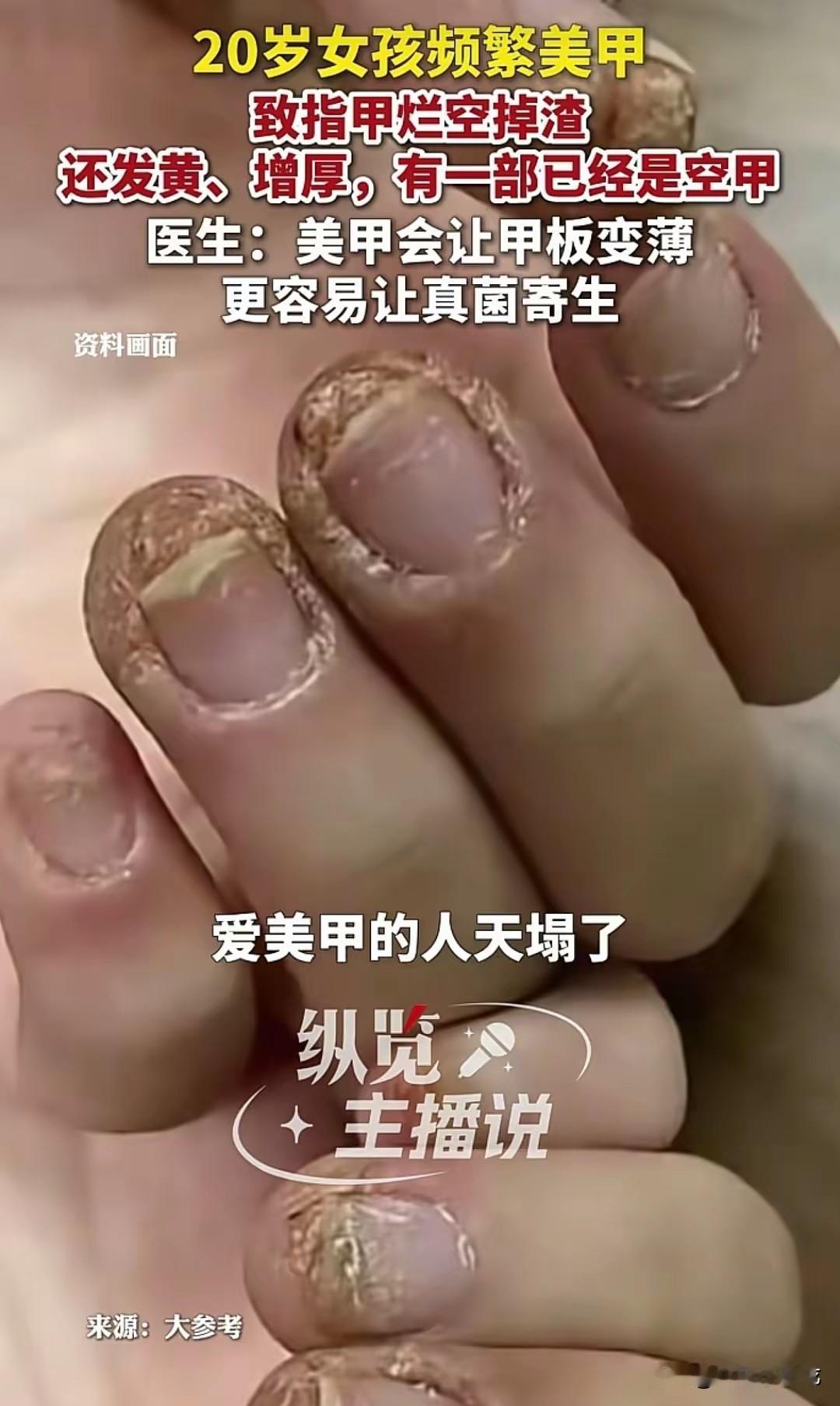 一个20岁姑娘，​​隔三差五就换美甲款式，打磨指甲把甲板磨得薄薄的，指甲烂得空了