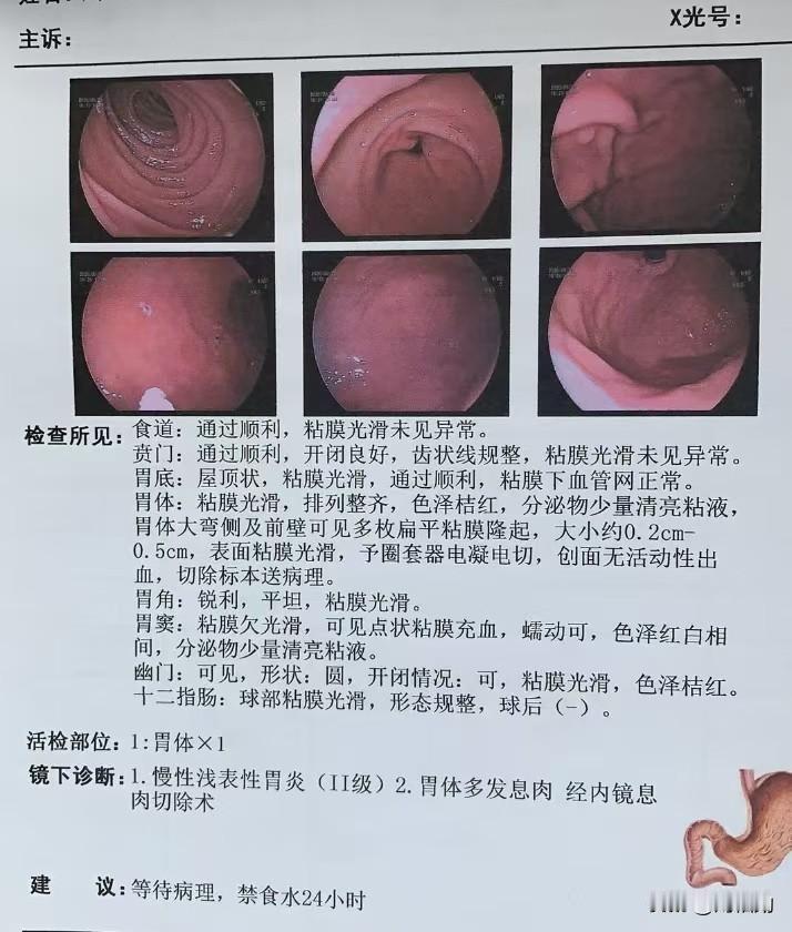舅妈昨天在沈阳市第六医院做了胃肠镜检查。胃镜提示慢性浅表性胃炎，胃体大弯侧和前壁