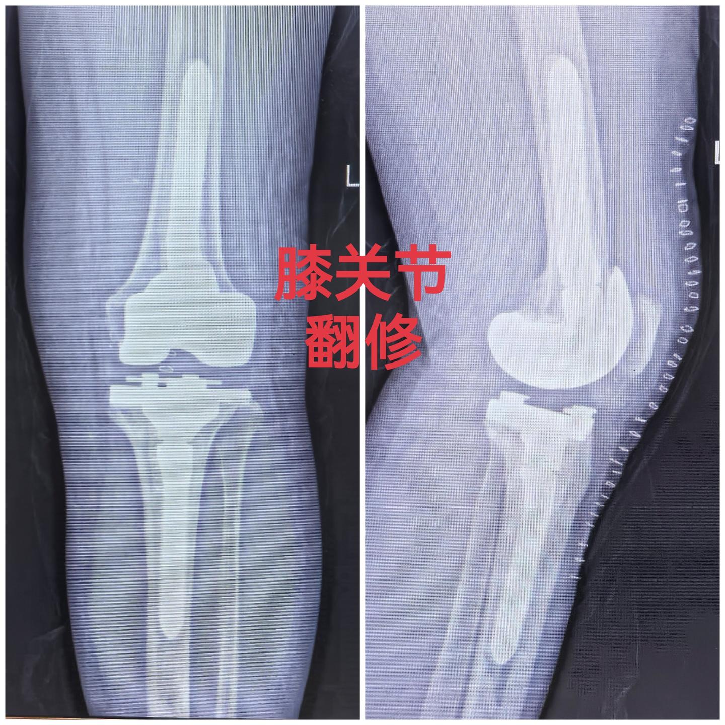 膝关节翻修。初次膝关节置换术后17年，80岁高龄，顺利翻修，希望再次延...
