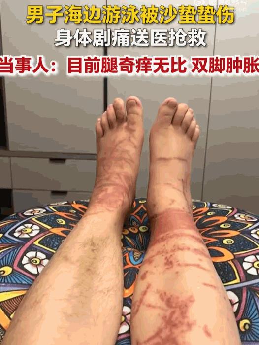 万万没想到！山东日照一男子下海游泳，在浅水区突然遭遇了水下 “隐形杀手”，瞬间像