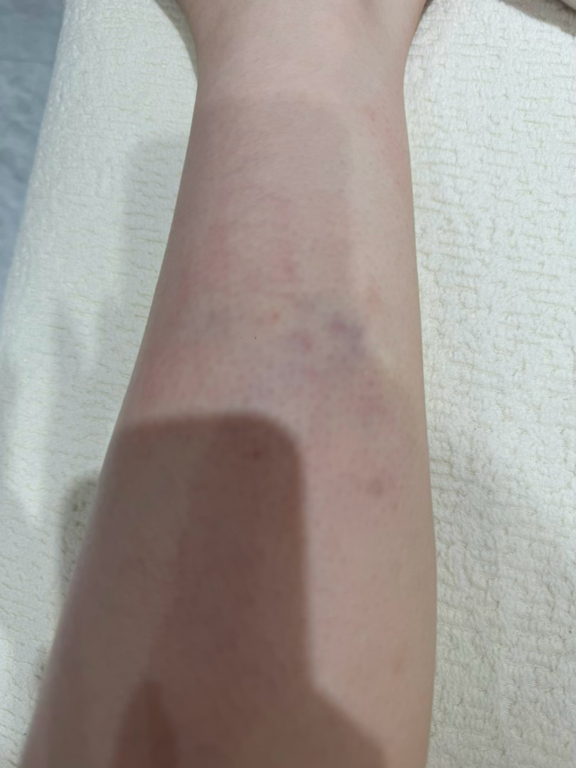 我直播不是腿被蚊子咬了很痒吗 然后随便一扣就青了… 666吧 6吧 厉害呗 行呗