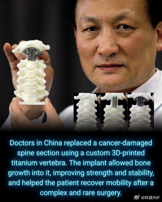 【中国医生成功用3D打印钛合金替换人体脊柱】在北京，中国医生取得了一项突破性的医