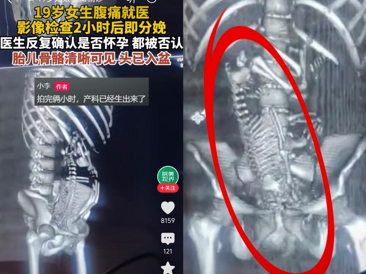 19岁女生腹痛就医
影像检查2小时后即分娩。
医生反复确认是否怀孕，都被否认意外