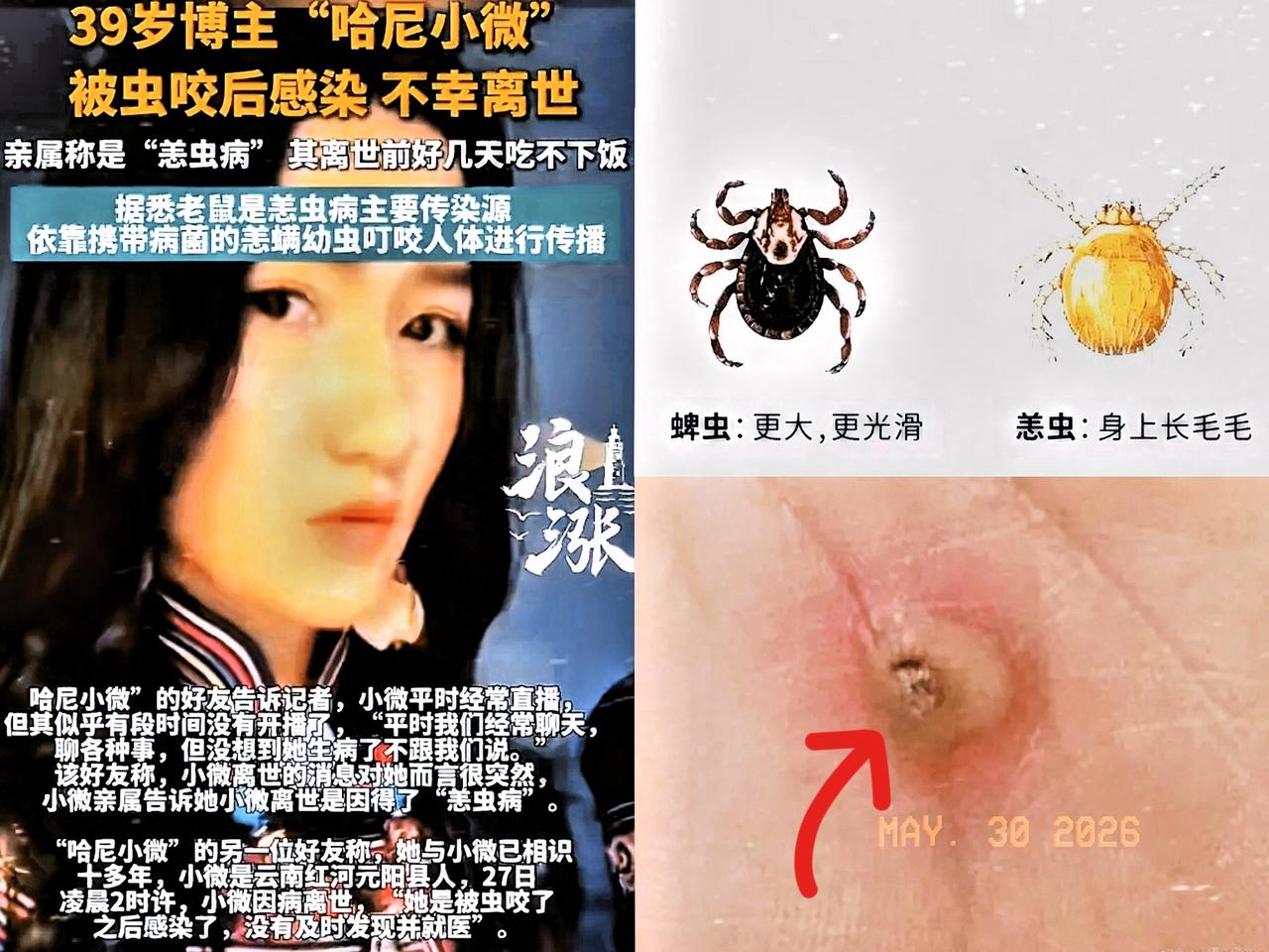 39岁，生命戛然而止！
仅仅被一只虫子咬了一口，
人就没了，只因不当回事，生生扛