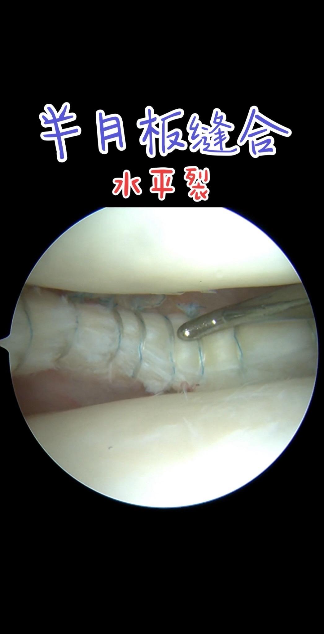 半月板缝合。是一种用于治疗半月板损伤的手术方法。半月板是位于膝关节股骨...