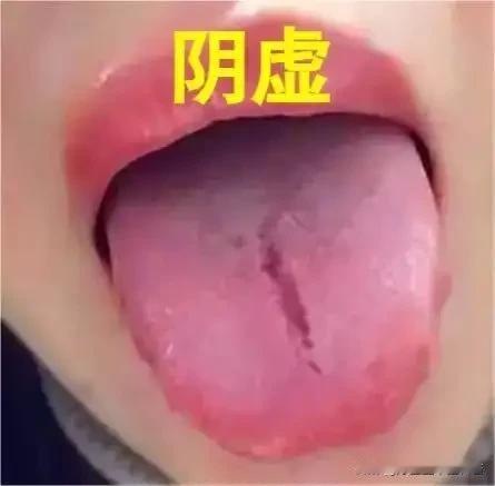 阴虚裂纹舌：阴液亏虚生虚火，这样调精准补阴降火
 
阴虚裂纹舌是中医阴虚证的典型