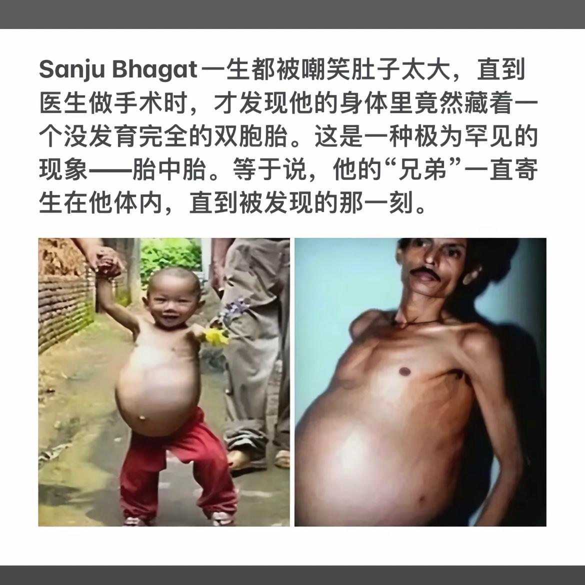 “肚子里的秘密：罕见胎中胎双胞胎”📸👶🏻👶🏻